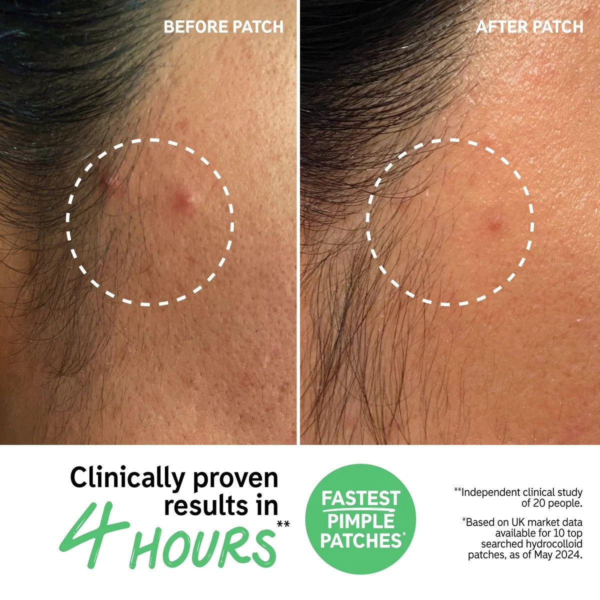 The INKEY List Hydrocolloid Invisible Pimple Patches